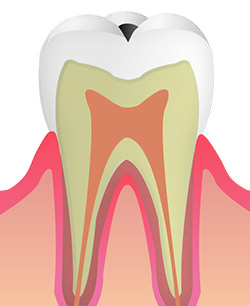 C1：歯の表面（エナメル質）のむし歯