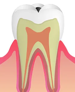 C1:歯の表面(エナメル質)のむし歯
