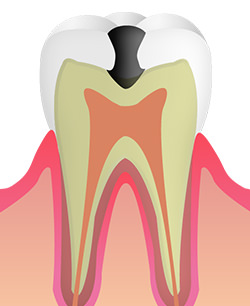 C2：象牙質のむし歯