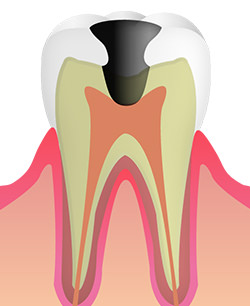 C3：神経（歯髄）まで達したむし歯
